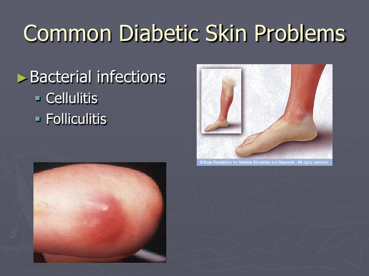 Diabetes And Your Skin 6741
